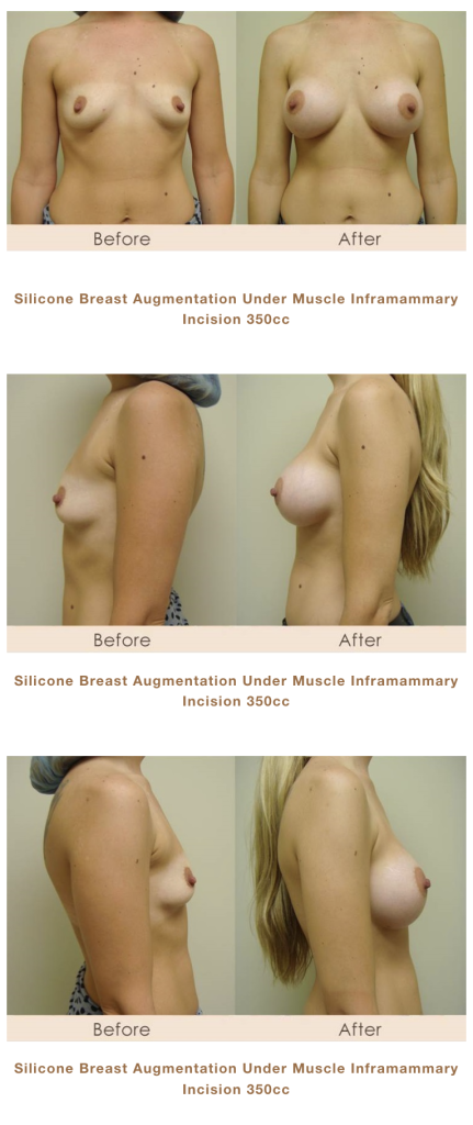 silicone breast augmentation in Michigan by Dr. Michael W. Gray.